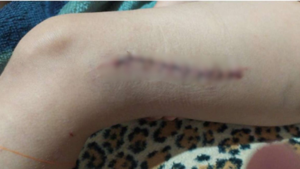 Menina, à época com seis anos, 'rasgou' a perna e precisou levar 11 pontos em Rio Preto (SP) — Foto: Arquivo pessoal