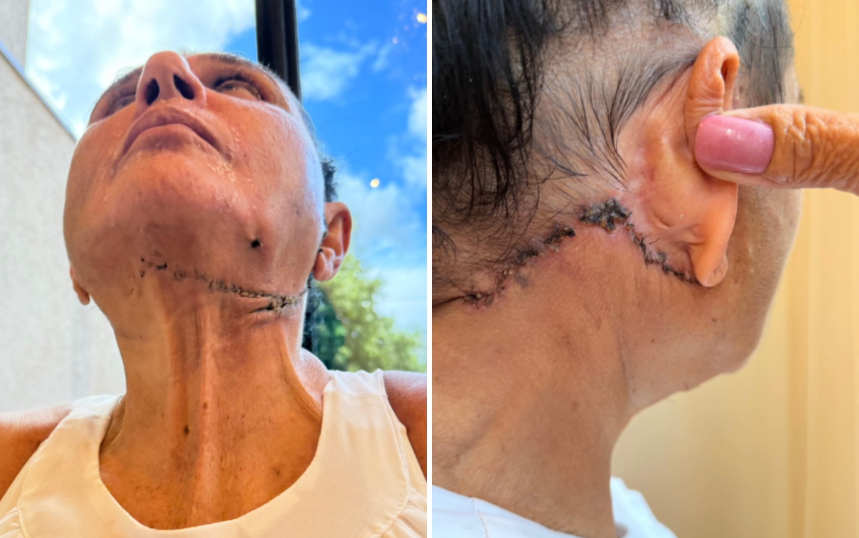 Mulher denuncia dentista após complicações em procedimento estético em Ribeirão Preto, SP