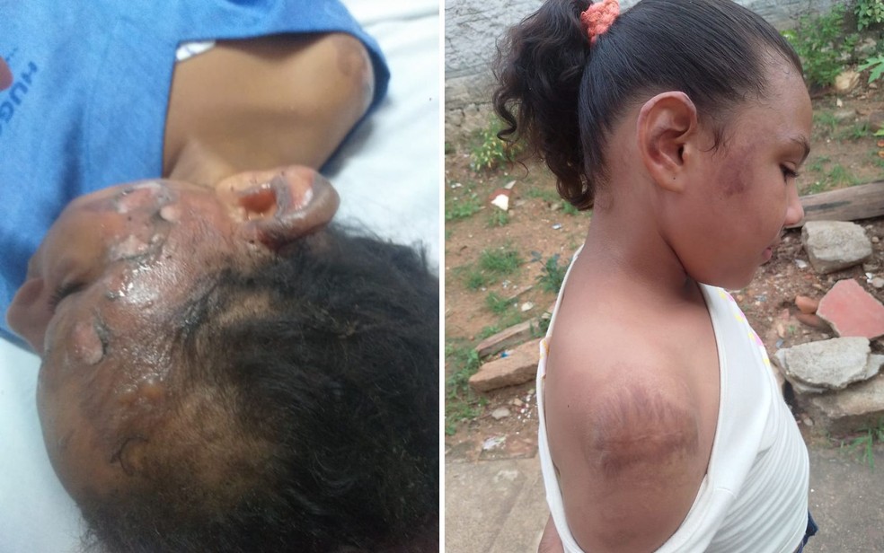 Na primeira imagem, Ysadora no hospital e na segunda, em casa, um mês depois — Foto: Arquivo pessoal/Emilia Constantino