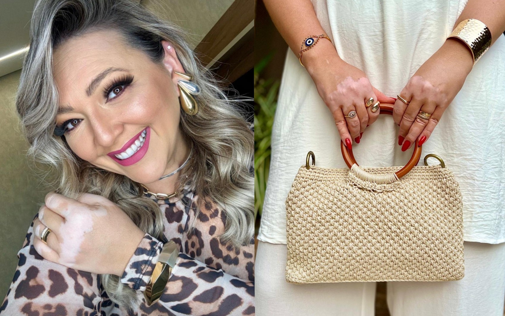 Blogueira com vitiligo há 10 anos transforma vivência em inspiração: 'Não me afeta mais'