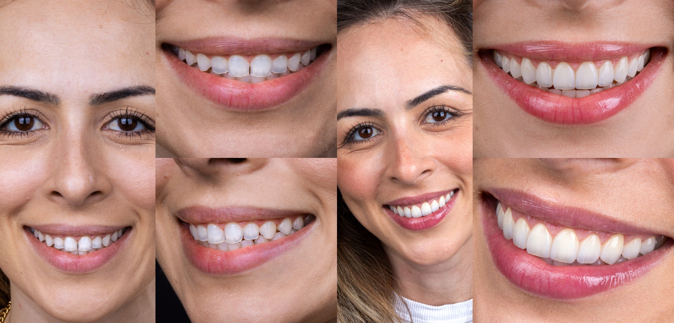 De Santos para o mundo: sorrisos naturais com lentes e implantes