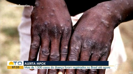 Especialista alerta para a doença Mpox que tem aumento em casos registrados no Brasil