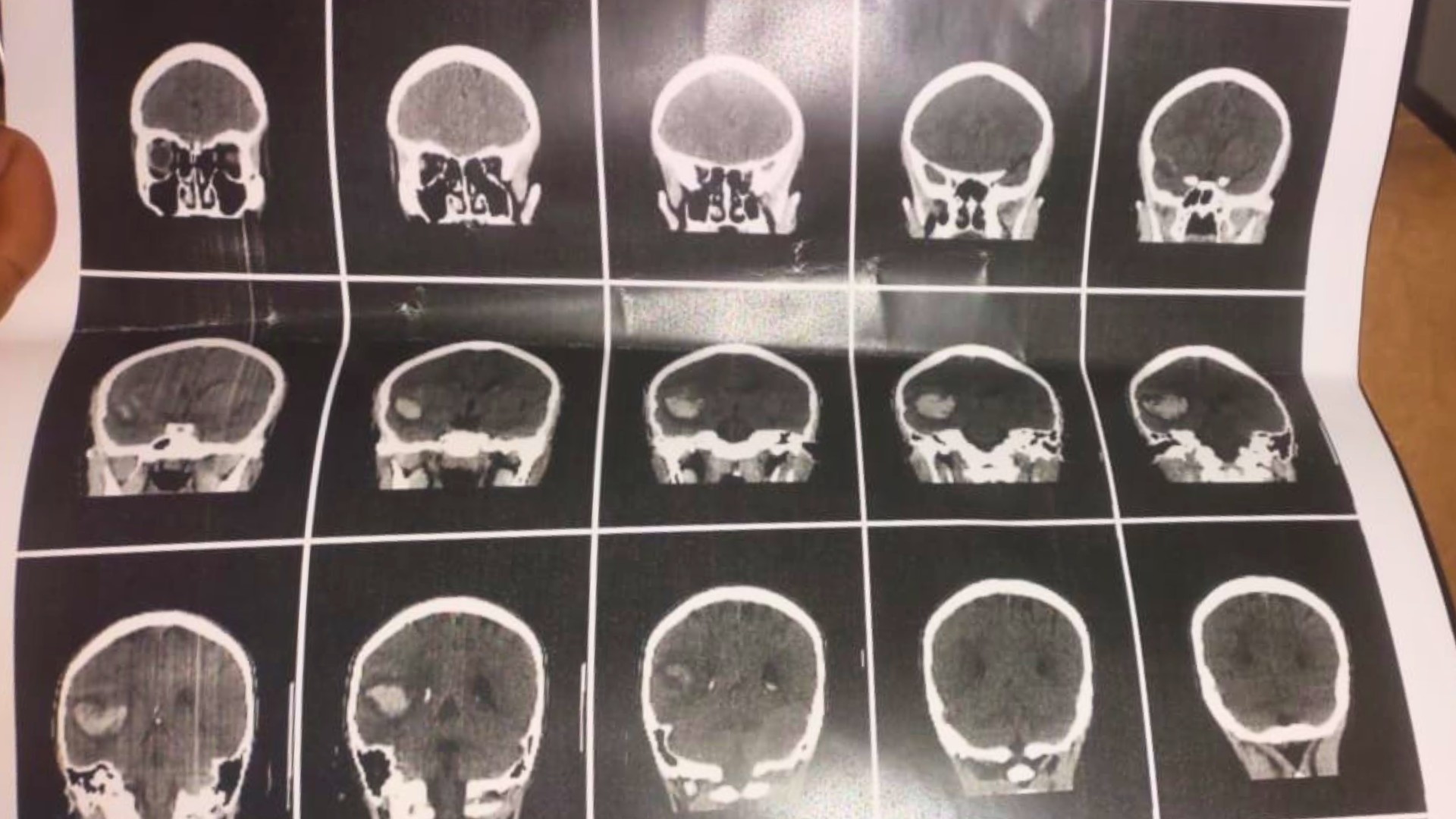 Adolescente é agredido com pá na cabeça por aluno em escola cívico-militar e sofre hemorragia cerebral