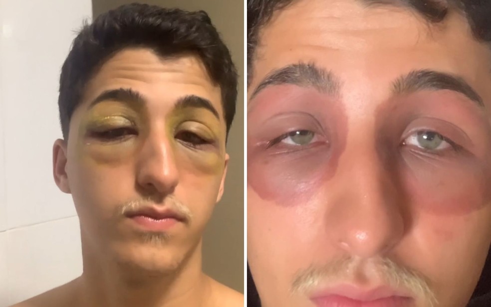 Gustavo Henrique de Moura Oliveira acordou com os olhos inchados e irritados, em Goiânia, Goiás — Foto: Reprodução/Redes Sociais
