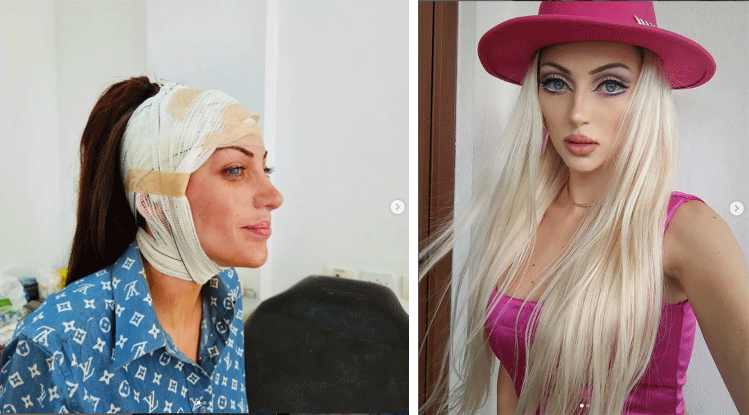 'Barbie humana' morta em SP fez 27 cirurgias para se parecer com boneca; veja quem era a influencer 