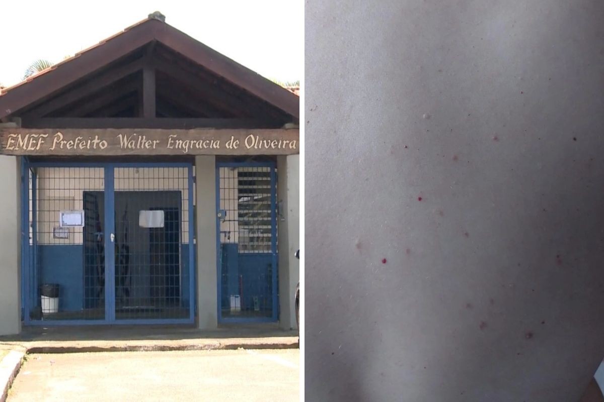 Suspeita de sarna afasta 54 pessoas de escola no interior de SP e prefeitura visita famílias: 'Acordo para coçar', diz servidora 