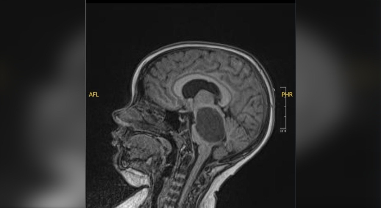 Novo teste pode identificar tipo de tumor cerebral em menos de duas horas e acelerar diagnóstico