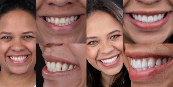 A arte da odontologia estética — Foto: Acervo Pessoal/Paciente Spazio Riso