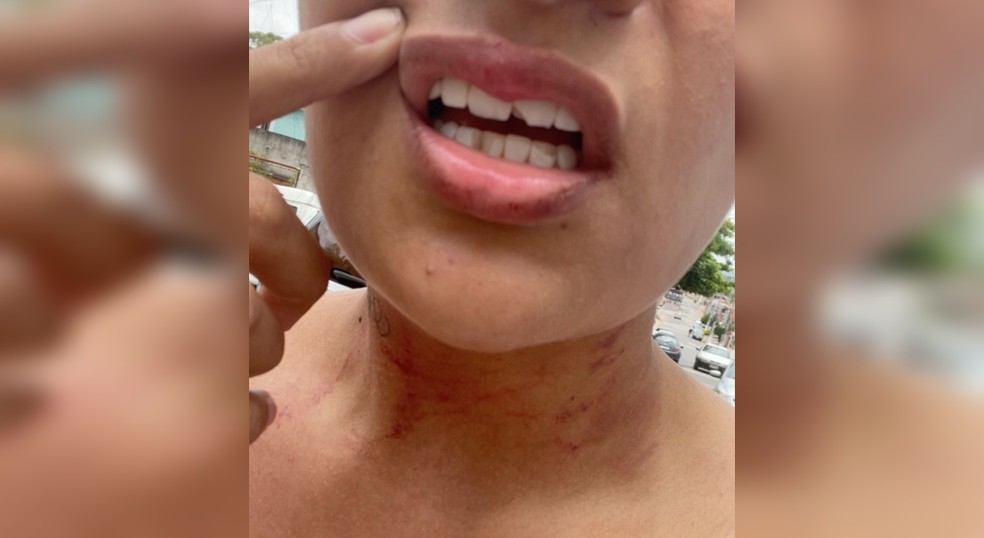Vítima ficou com hematomas no pescoço, arranhões e dentes quebrados após homem tentar lhe estuprar, em Sorocaba (SP) — Foto: Arquivo pessoal