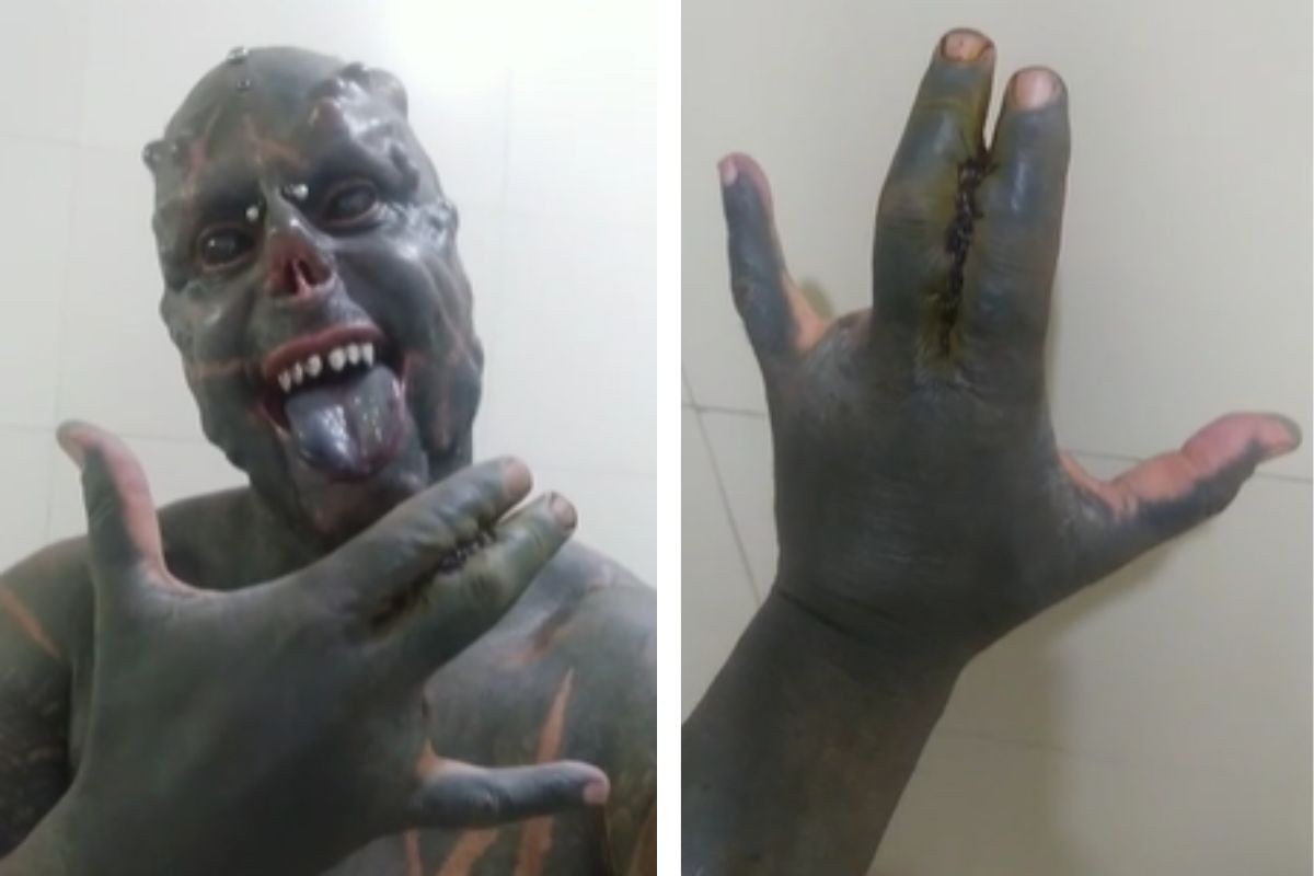 'Diabão' mostra resultado da 'unificação' dos dedos uma semana após modificação corporal — Foto: Reprodução/Redes Sociais