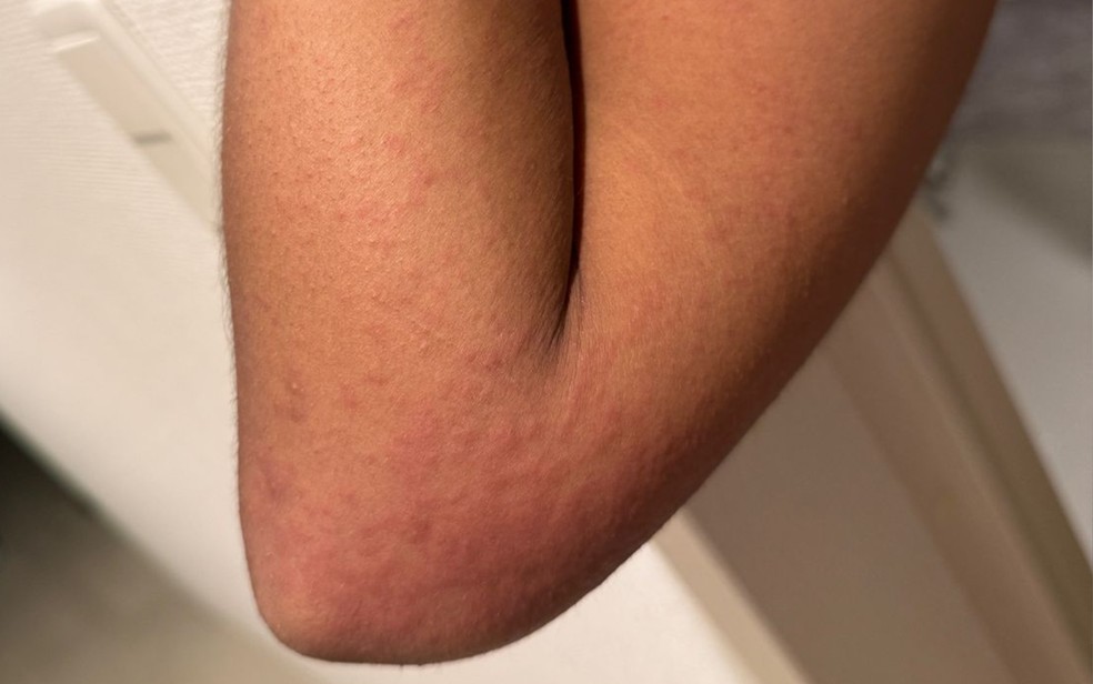 Baiana teve reações alérgicas após segunda dose da vacina. — Foto: Arquivo Pessoal