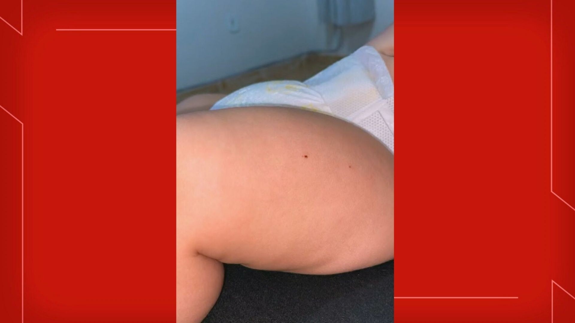 Agulha de adulto é usada em bebê de 4 meses sem aviso em UBS no DF, denuncia mãe