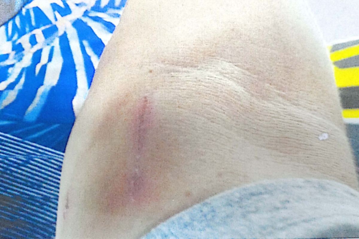 Justiça nega indenização a servidor agredido com enxada por colega de trabalho no litoral de SP