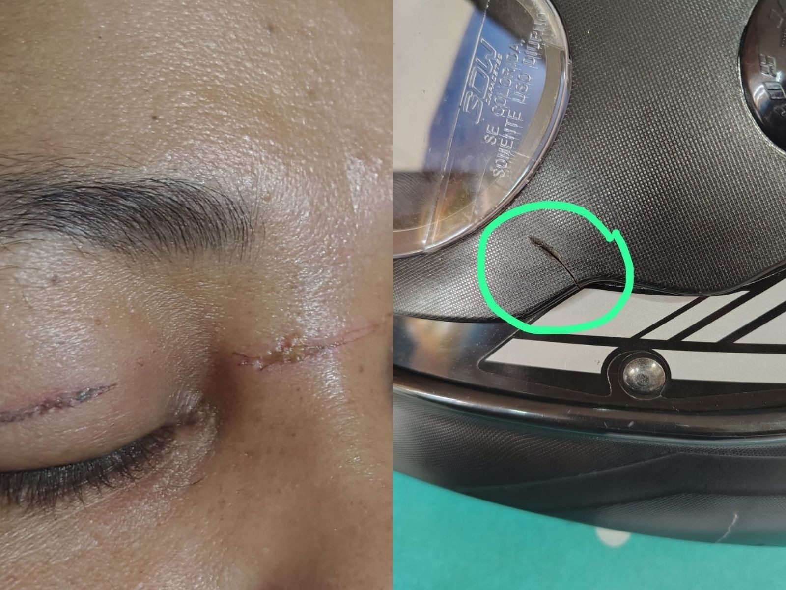 Diarista sofre cortes no rosto e pescoço por linha de pipa ao andar de moto no AC: 'Nasci de novo'