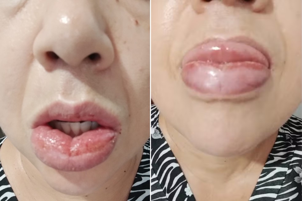 Educadora social, de 45 anos, sofre reação alérgica após uso de pasta de dente, em Miracatu (SP) — Foto: Arquivo pessoal