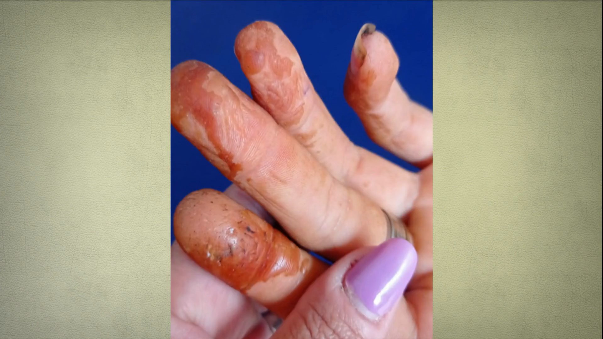 Mãos queimadas e trabalho infantil: desafios da produção artesanal da castanha de caju no Rio Grande do Norte