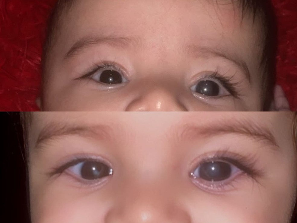 Reflexo branco nos olhos da bebê chamou a atenção da mãe e levou à investigação que confirmou o diagnóstico de catarata congênita — Foto: Arquivo pessoal