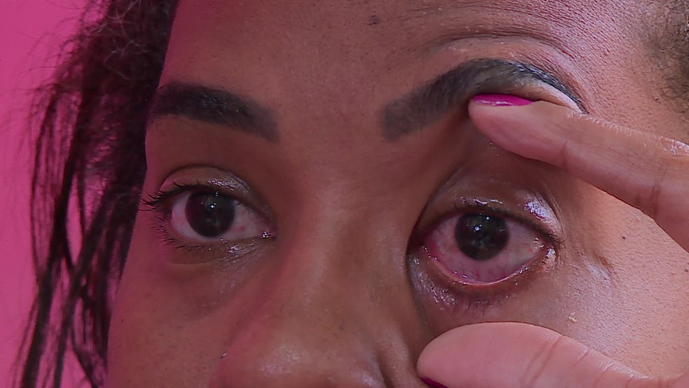 Ridja Dutra teve queimadura na retina após usar pomada modeladora  — Foto: Reprodução/TV Globo