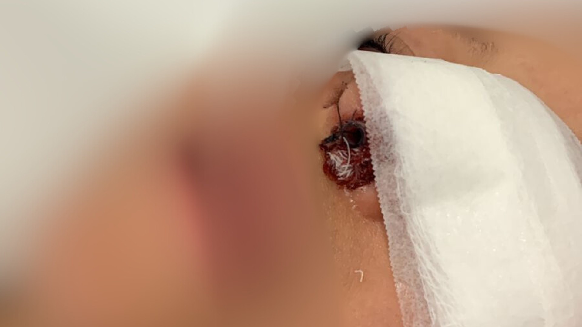 Criança sofre fratura no nariz e passa por cirurgia após ser empurrada em escola de Araçatuba: ‘Estou arrasado’, diz pai
