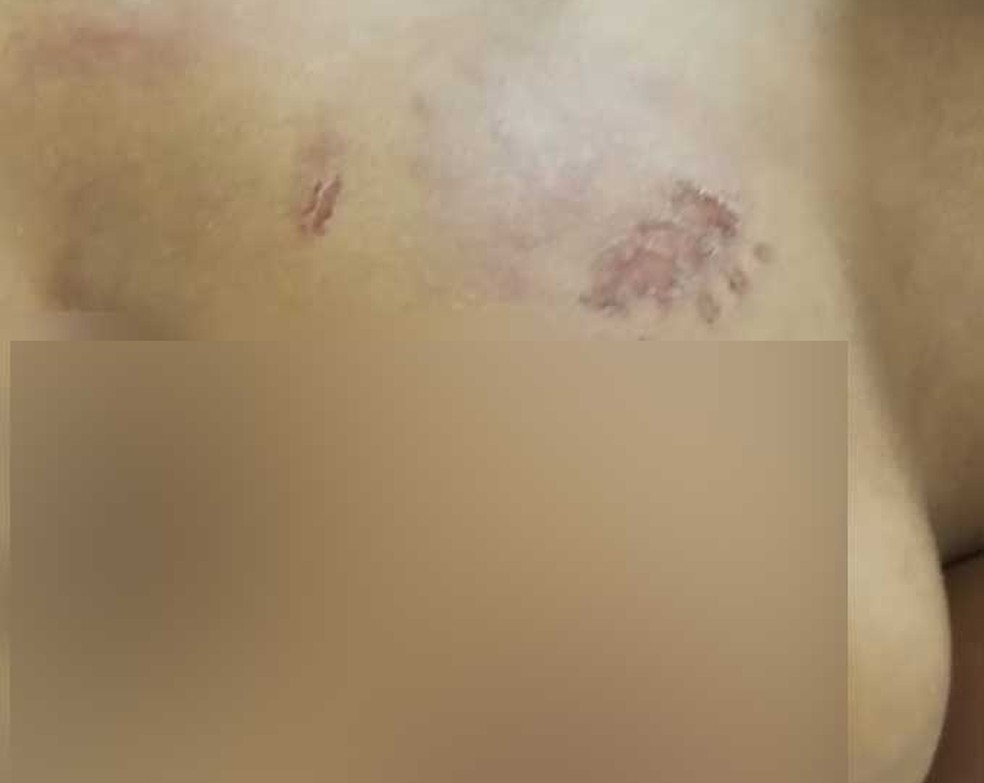 Marcas da violência sofrida pelo menino — Foto: Reprodução