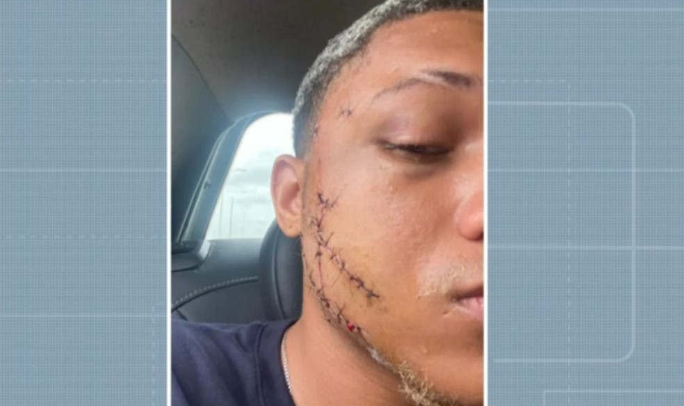 Jovem leva 37 pontos no rosto após ser agredido com garrafa de vidro ao separar briga em saída de festa na Bahia — Foto: Reprodução/TV Bahia