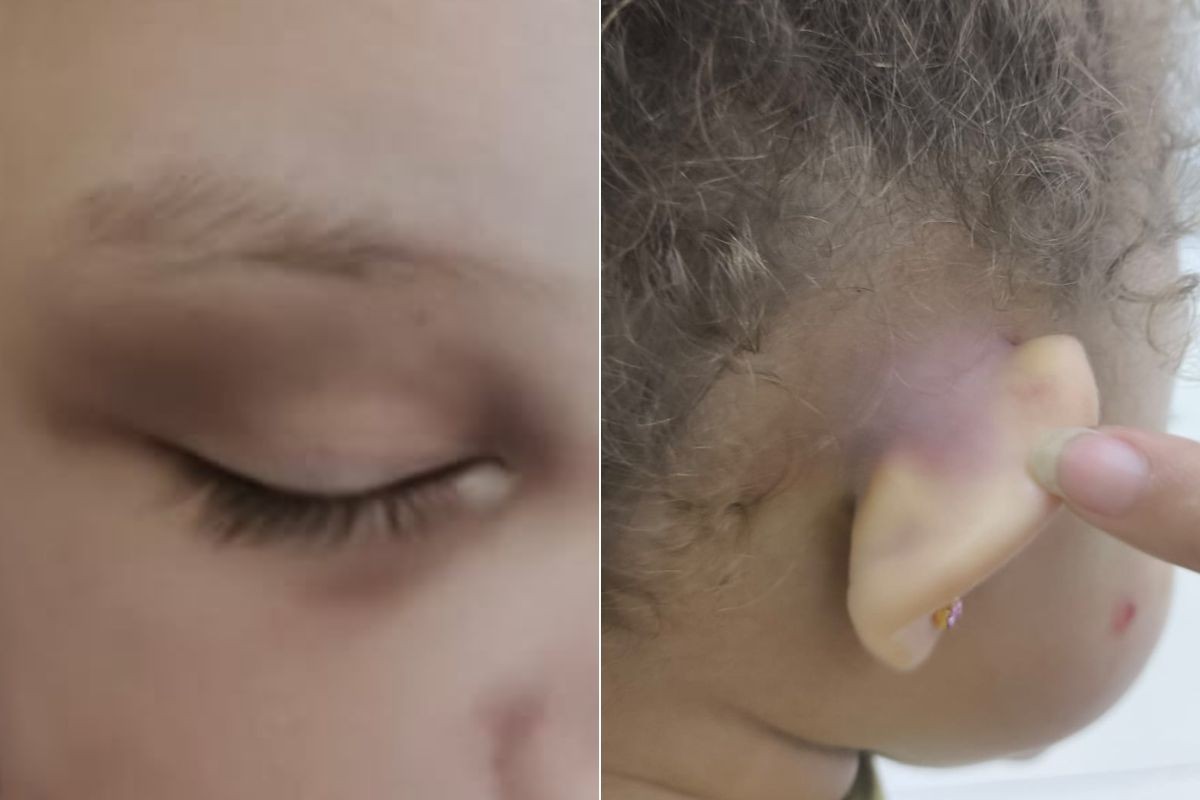 Pai denuncia creche após buscar criança com hematomas no litoral de SP: 'Sem respostas'; VÍDEO