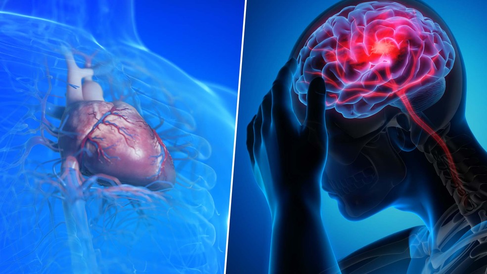 Causas da morte do papa Francisco: entenda quadro de AVC e insuficiência cardíaca | Saúde | G1