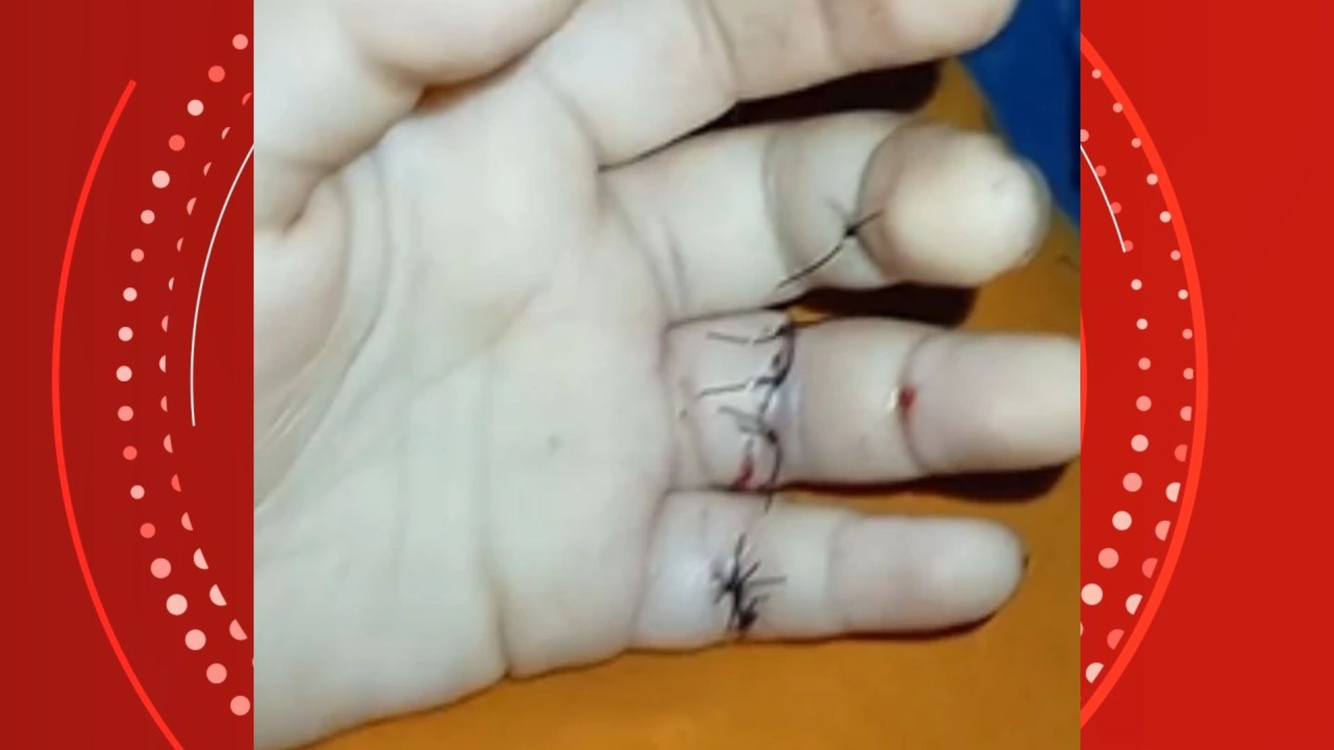 Criança de 5 anos tropeça com prato de vidro nas mãos e corta dedos em escola na Serra
