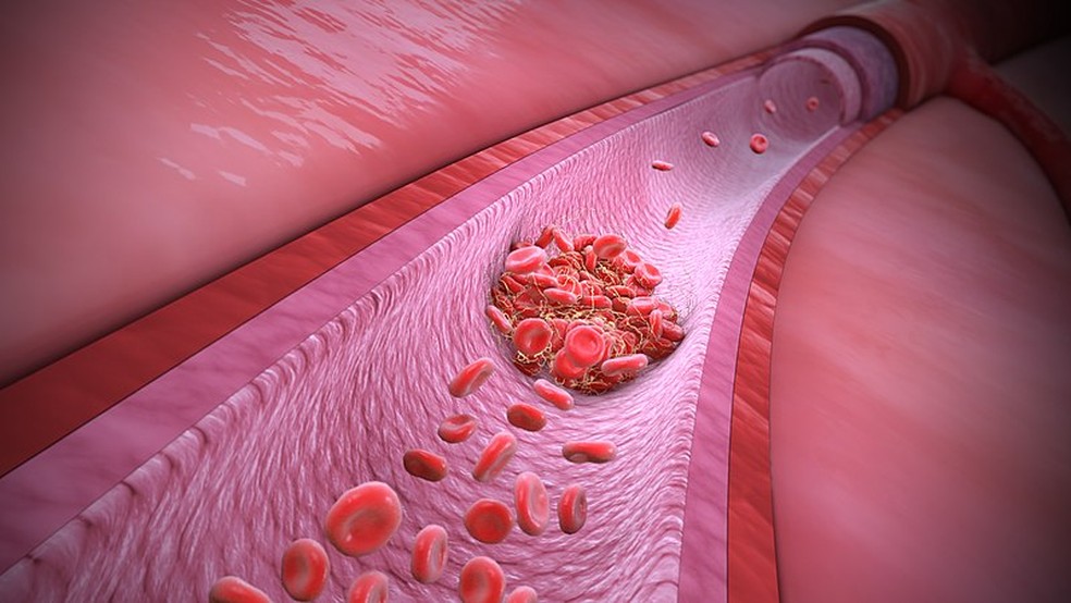 Ilustração mostra um exemplo de trombofilia, condição que aumenta o risco de coágulos sanguíneos. — Foto: Wikimedia Commons/Domínio Público