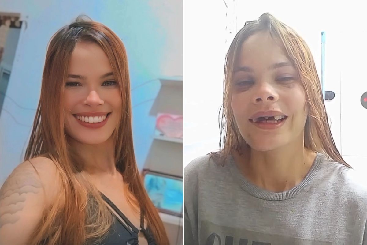 Jovem perde cinco dentes em acidente de moto e sonha com prótese: 'Foi como perder a minha identidade'