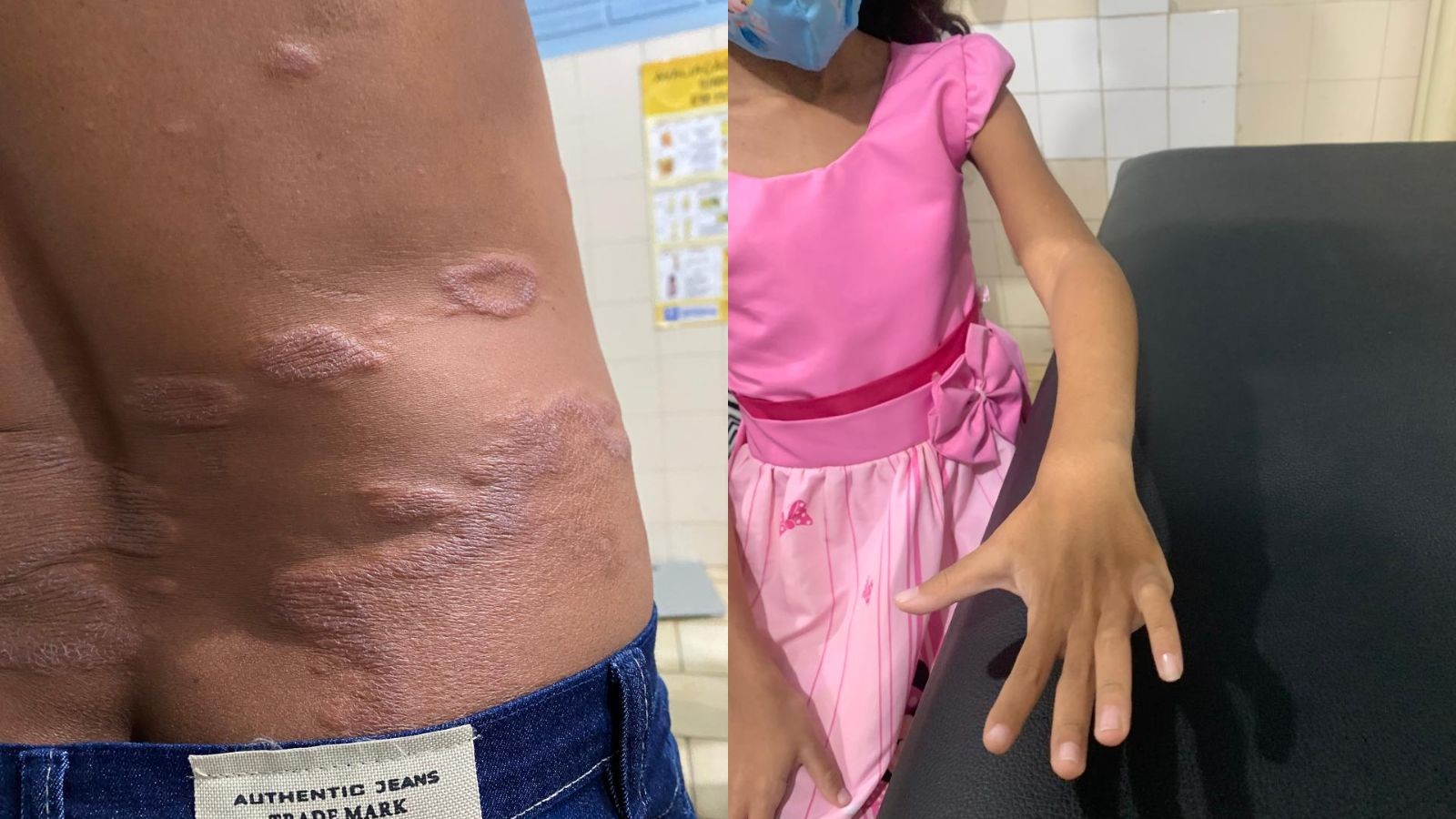 Piauí tem quinta maior taxa de hanseníase do país, aponta boletim