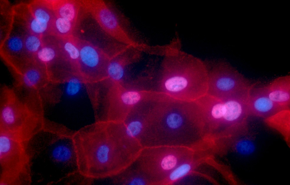 Cultura de células de câncer de mama vistas em microscópio eletrônico. — Foto: Ewa Krawczyk, National Cancer Institute/Georgetown Lombardi Comprehensive Cancer Center