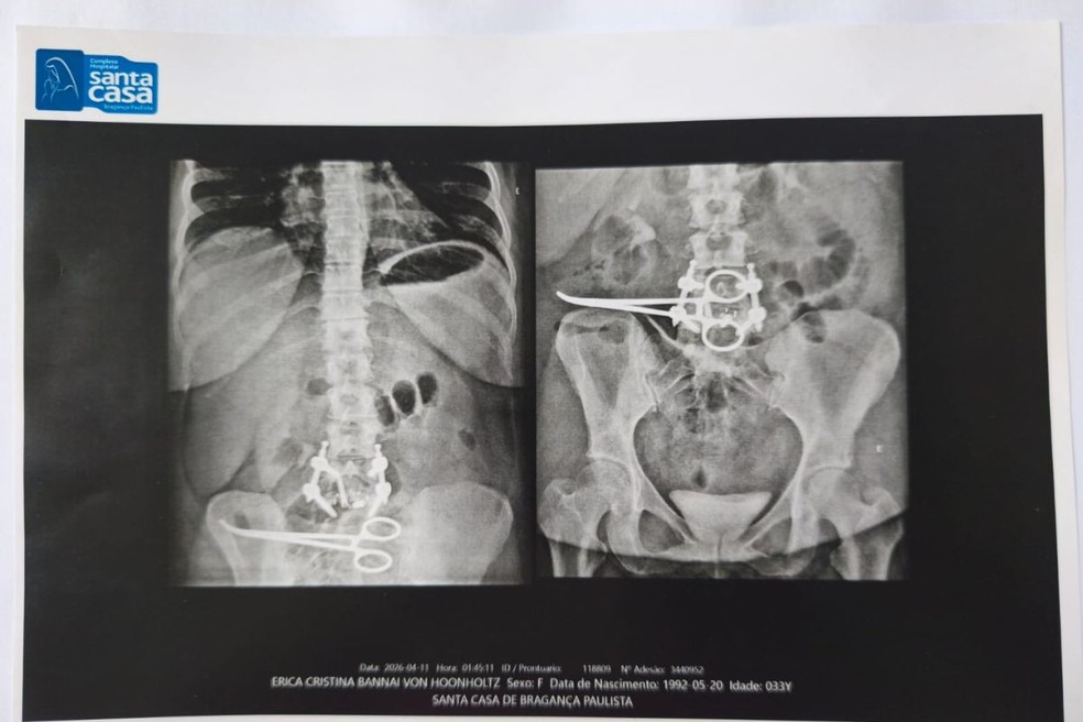 Raio-X mostra a pinça cirúrgica encontrada no abdômen da paciente após a cirurgia em Bragança Paulista. — Foto: Reprodução/Arquivo pessoal