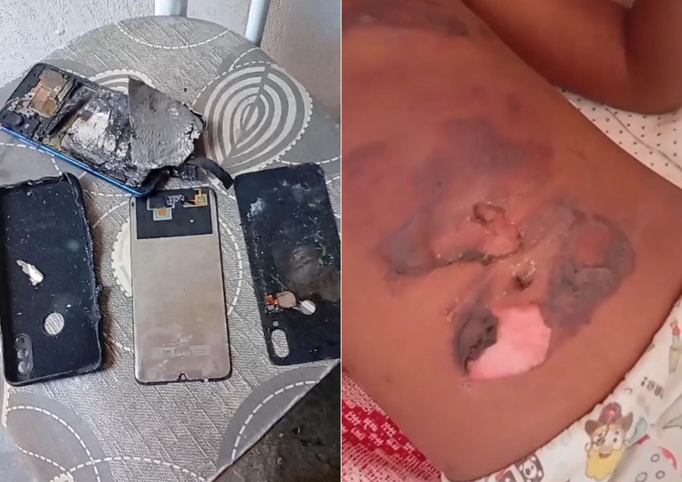 Celular pega fogo e criança de 10 anos sofre queimaduras no interior do RN — Foto: Reprodução