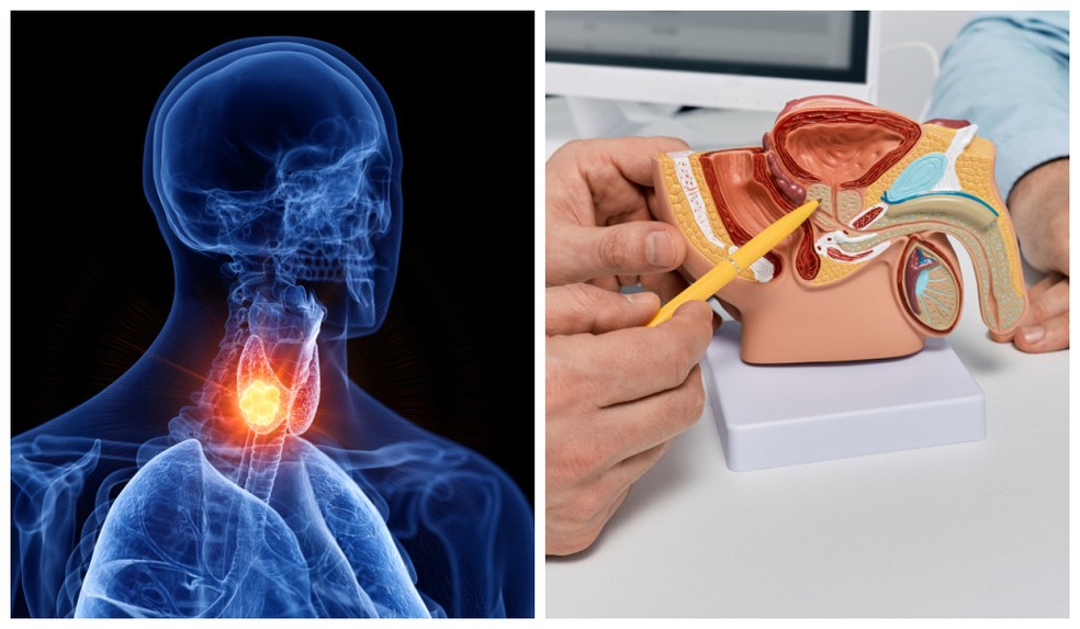 Bloqueio de hormônio da tireoide impede crescimento de tumor de próstata, aponta estudo — Foto: Adobe Stock