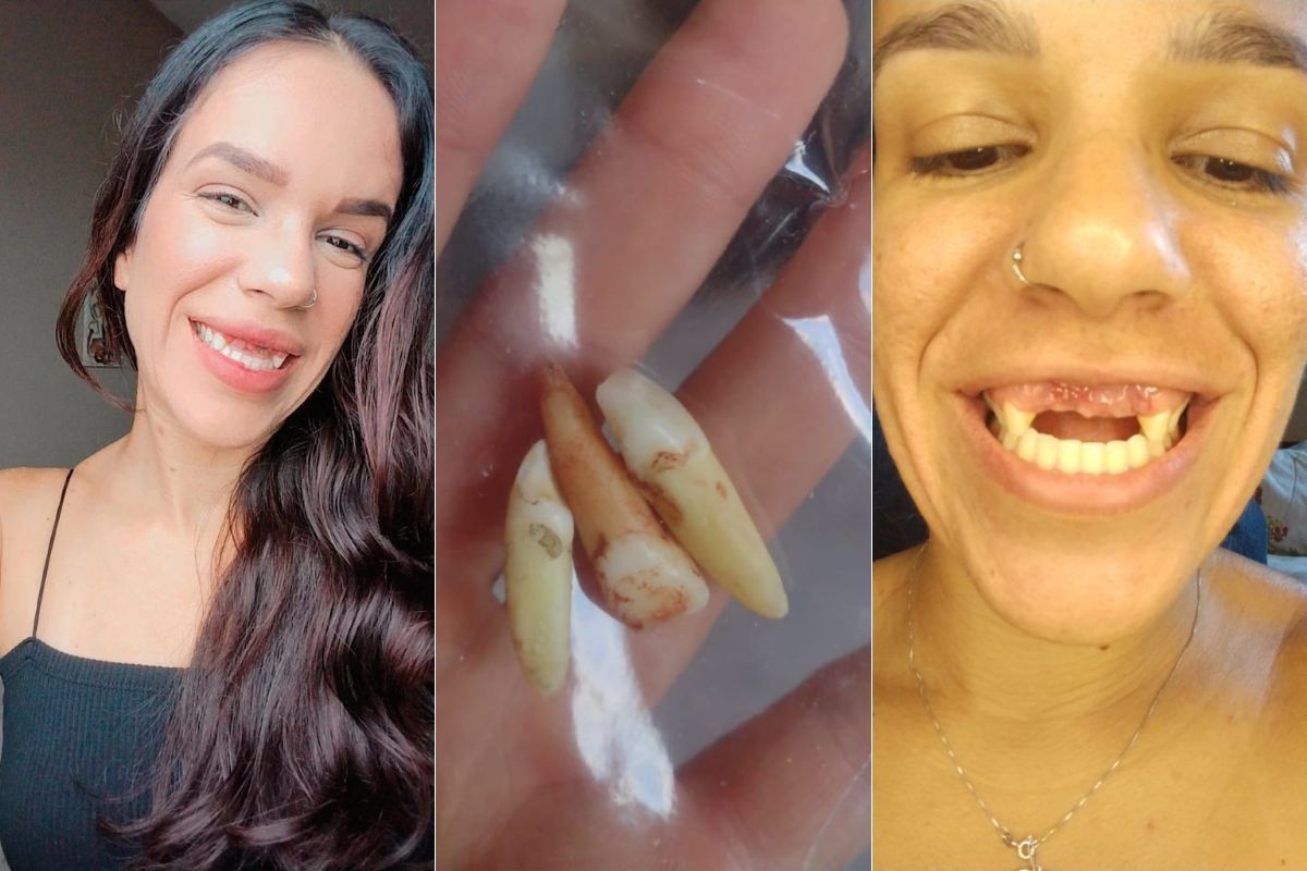Mulher perde dentes em acidente, 'reaprende' a comer e luta por implante dentário