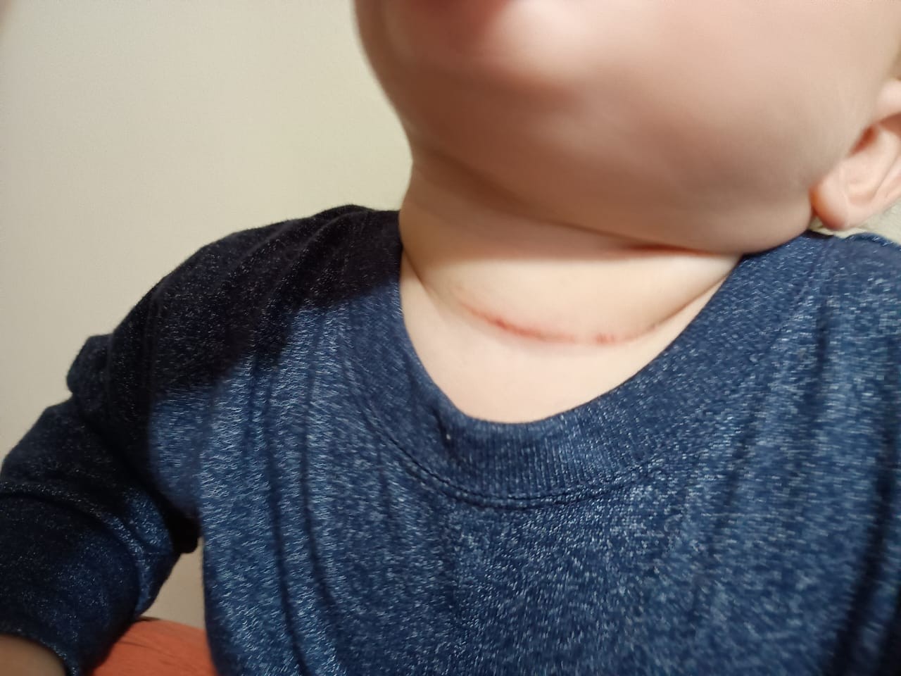 Bebê fica com pescoço ferido após ser atingido por linha chilena e mãe cobra fiscalização: 'Poderia ter sido uma tragédia'