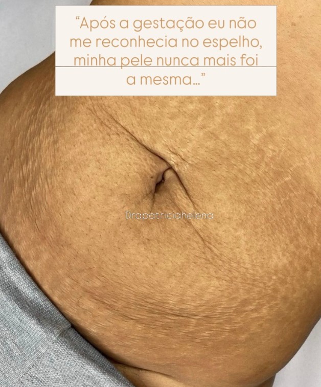 Autoestima sem estrias? Especialistas falam sobre impacto