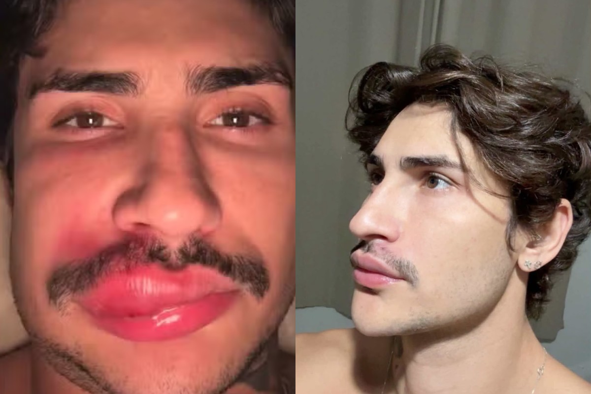 Antes e depois: como ficou rosto de influencer 'Ken de CG' após infecção ao espremer espinha