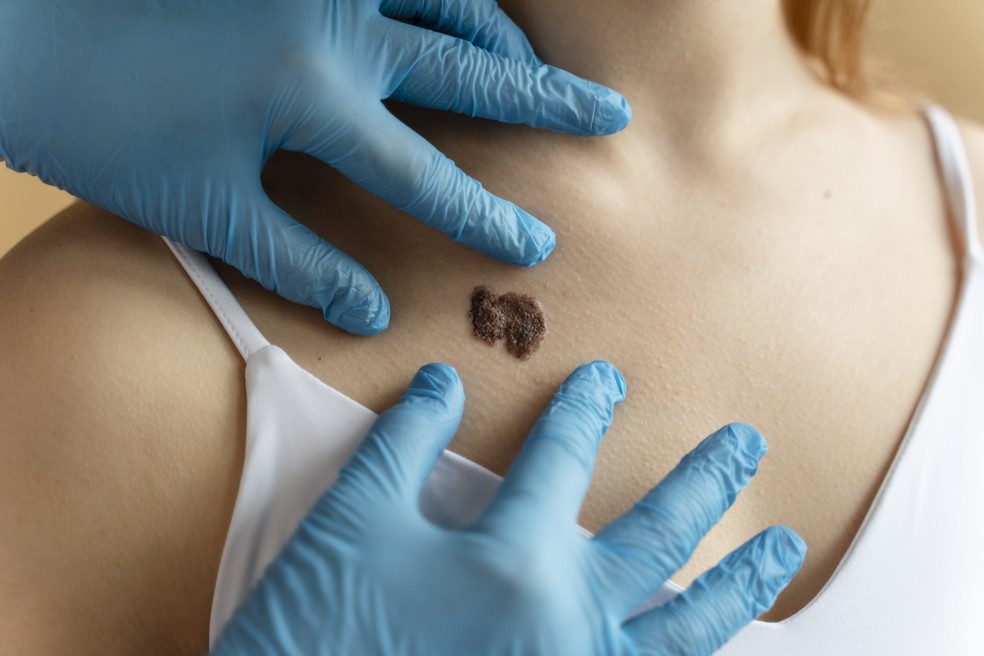 Melanoma é um dos cânceres de pele mais agressivos que existem. — Foto: Freepik