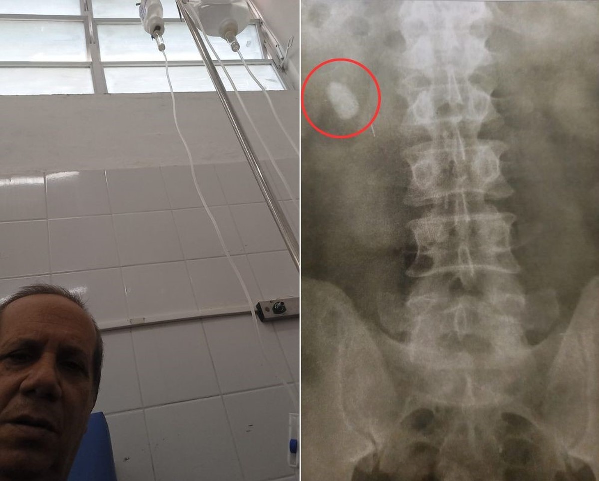 Un hombre con cálculos renales espera tratamiento desde hace 12 años en la costa de SP: ‘Abandonado’ |  Más salud