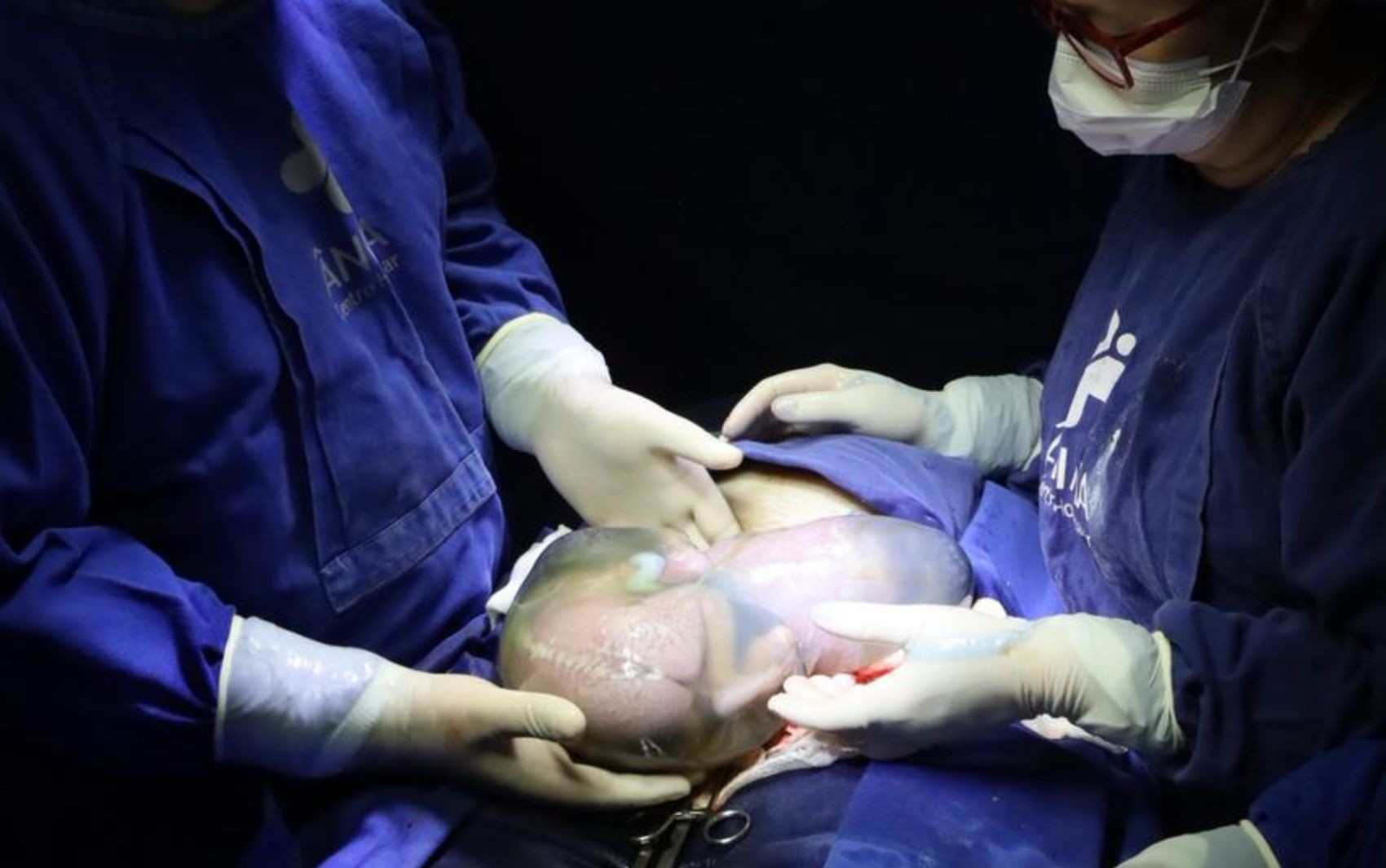 Nascimento de trigêmeos com dois bebês empelicados emociona equipe médica, em Goiás