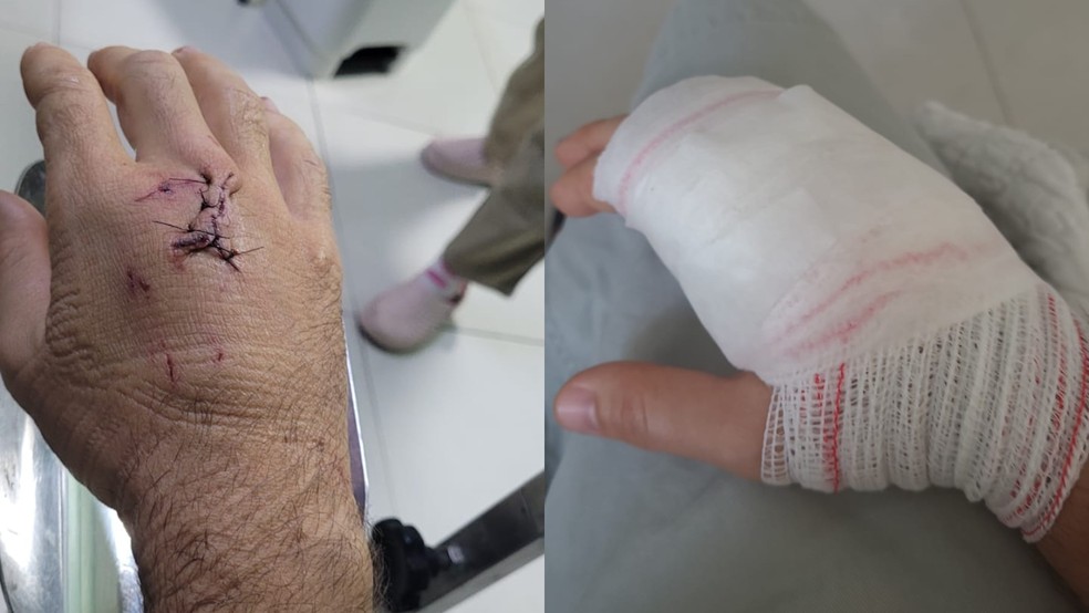 João Vitor teve ferimento na mão após ser atacado por cachorro no Parque do Cocó, em Fortaleza. — Foto: Arquivo pessoal