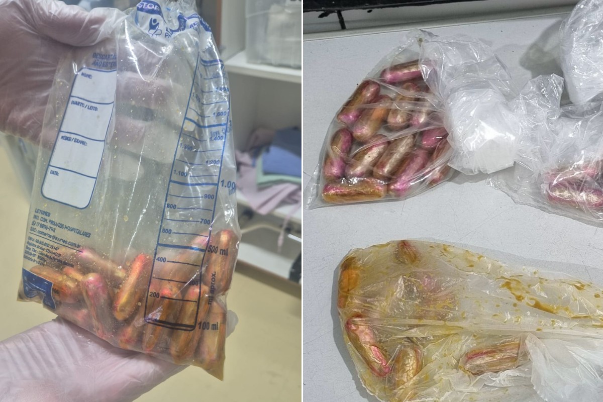 Boliviano é preso após relatar mal-estar em hospital e raio-X identificar cápsulas de drogas no intestino