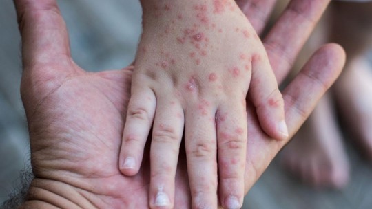 Humanos podem pegar febre aftosa? Entenda como quadro de filha de Tays Reis pode servir de alerta para doenças infantis - Quadro é muito raro em humanos e depende do contato íntimo com animais. Já a síndrome mão-pé-boca é comum e muito infecciosa, e pode causar sintomas semelhantes.