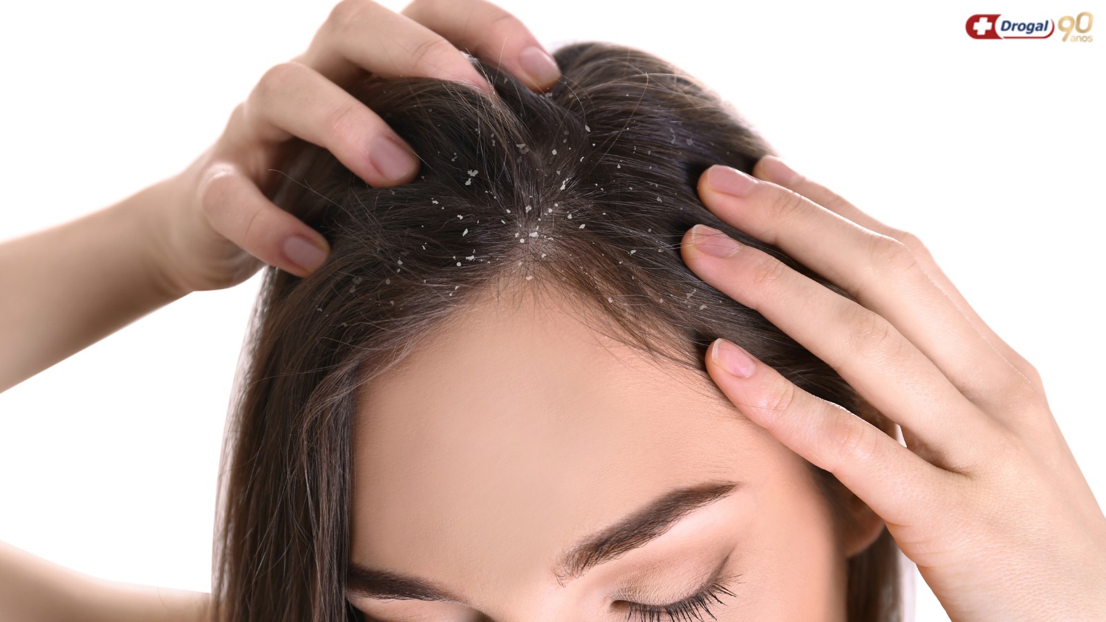 Caspa causa queda de cabelo? Entenda a relação e os possíveis tratamentos