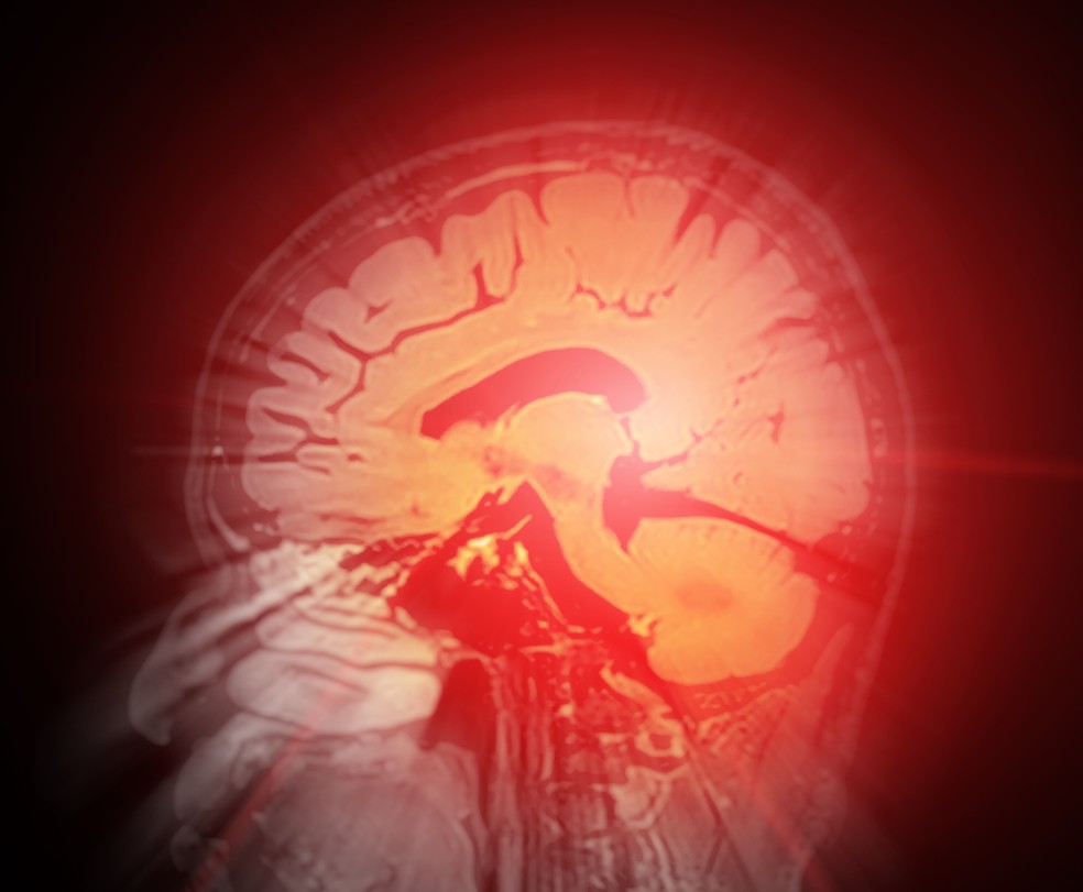 Hemorragia cerebral — Foto: Adobe Stock