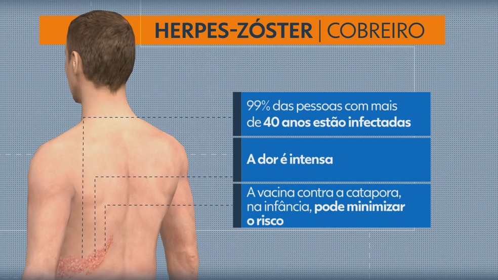 Herpes-zóster — Foto: TV Globo/Reprodução