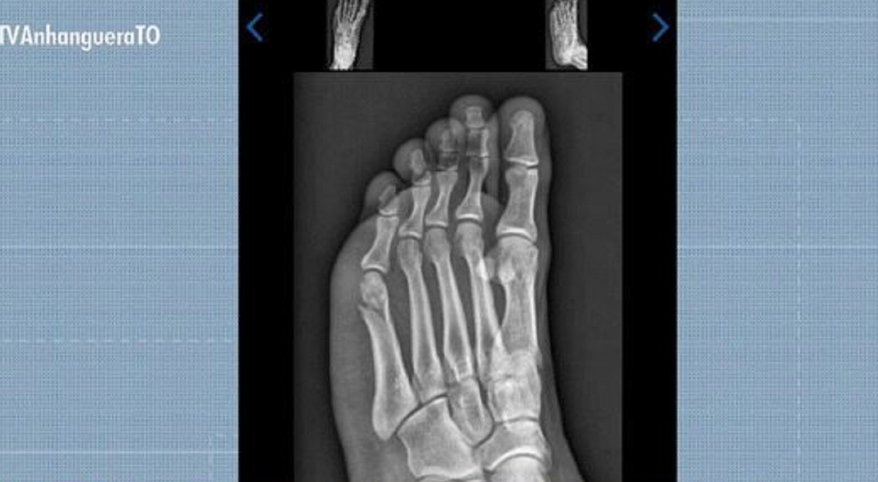 Candidato faz teste físico da PM com fratura no pé e consegue aprovação: 'Pensei que não ia conseguir'