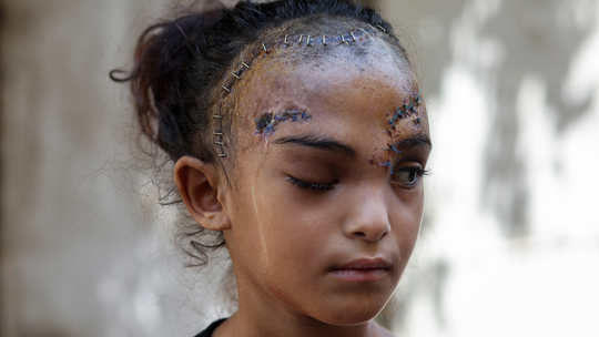 Ferida, palestina de 7 anos sonha com tratamento no exterior - Foto: (REUTERS/Ramadan Abed)